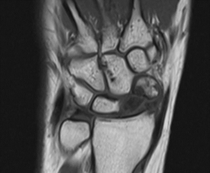 Carpal Instability Dissociative (CID) Scaphoid Nonunion Advanced Collapse (SNAC wrist) Scaphoid fracture, especially non-union fractures, with distal scaphoid fracture segment flexion, and resulting