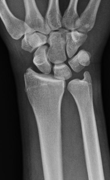 In type II ulnar translocation, the radioscaphoid joint is maintained with ulnar shift of the remaining proximal carpal row.