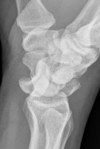 Carpal Instability Complex (CIC) Group 1: Dorsal Perilunate Dislocation Stage IV: Lunate dislocation: Capitate pulled proximal and volar by the intact radioscaphocapitate extrinsic ligament.
