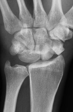 Carpal Instability Complex (CIC) Group II: Dorsal perilunate fracturedislocation Perilunate dislocation + carpal bone fracture