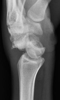 radiographs of the wrist demonstrating a perilunate fracture-dislocation.