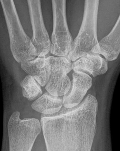 Radiologic Evaluation of the Wrist Plain film radiographs offer an adequate cursory evaluation of carpal instability.