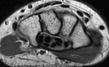 Radiologic Evaluation of the Wrist MRI provides a more