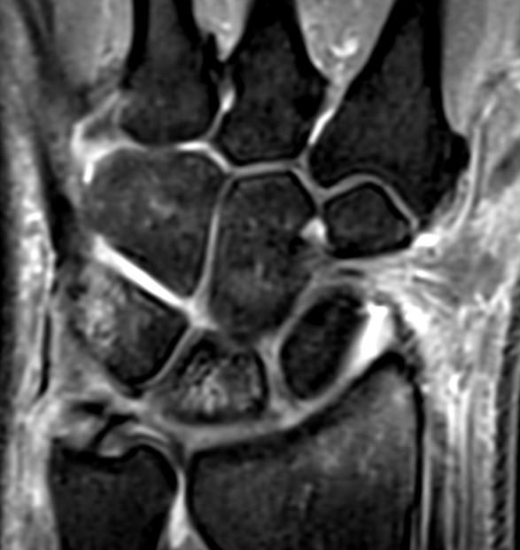 association with scaphoid fractures A B Axial T1 (A) and Coronal PD FS (B) MRI, and frontal radiograph