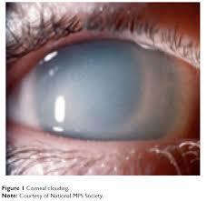 Ocular Corneal