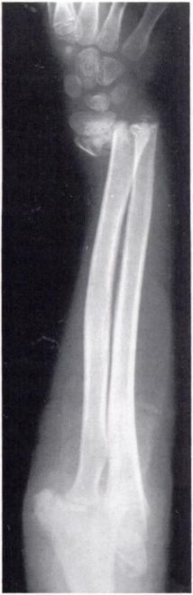 792 P. A. TEPLETON. H. KERR GRAHA Fig. 2a Fig. 2b Radiographs showing a grade-3 comminuted extension supracondylar fracture and a completely displaced fracture of the distal radial metaphysis (a).