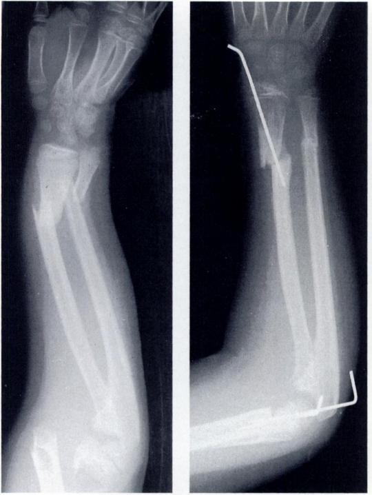 THE FLOATING ELBOW IN CHILDREN 795 Radiographs showing a floating elbow with diaphyseal fractures of the distal third of the radius and ulna.
