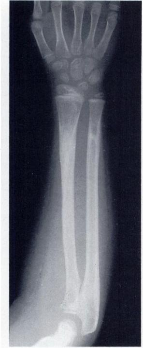 elbow fracture as has been suggested (Smyth 1956; Reed and Apple 1976; Papavasiliou and Nenopoulos 196). Traction does not offer anatomical reduction or access to the limb in these serious injuries.