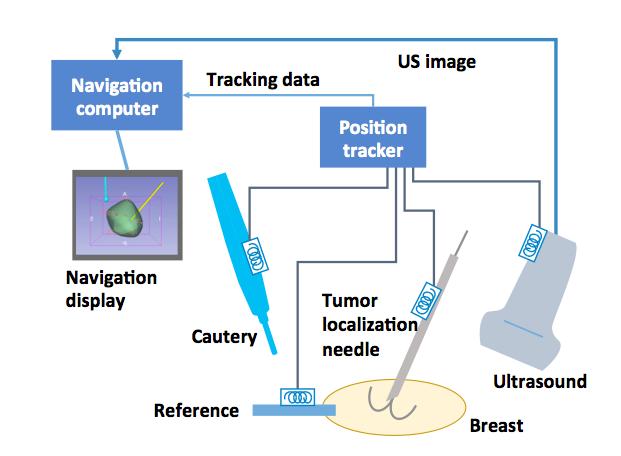 as a rigid body to track the lesion s location throughout the surgery. Prior to excision, the margins of the tumor are defined in the needle s coordinate system using tracked ultrasound images.