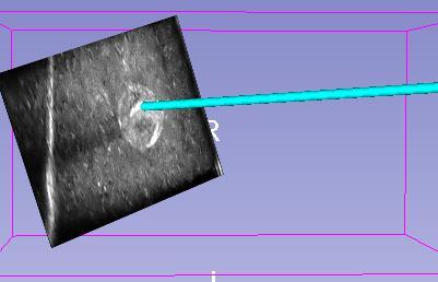 Figure 4: A 3DSlicer view of the setup, showing the hooked needle in cyan and the tracked ultrasound image 2.3 Data Analysis The recorded data were processed using the PLUS application (www.