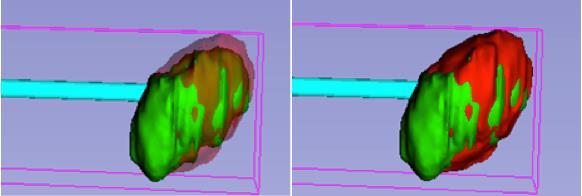 The same red segmentation is shown in the right image, superimposed on an ultrasound scan of the lesion in a deformed state.