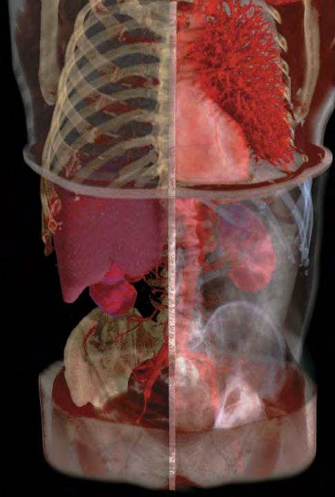 front of the heart representing several different rendering techniques. volume rendering software can be used to: isolate complete body systems such as bone.