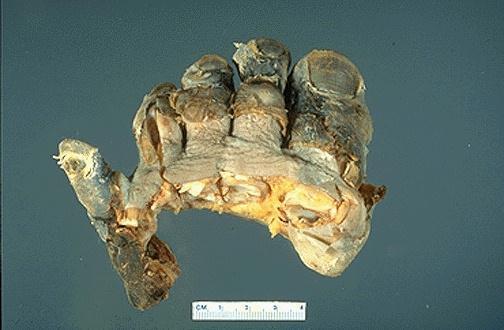 g. acute pancreatitis 5- Gangrenous necrosis: Necrosis (secondary to ischemia), usually with superimposed infection. Example: necrosis of distal limbs, usually foot and toes in diabetes.