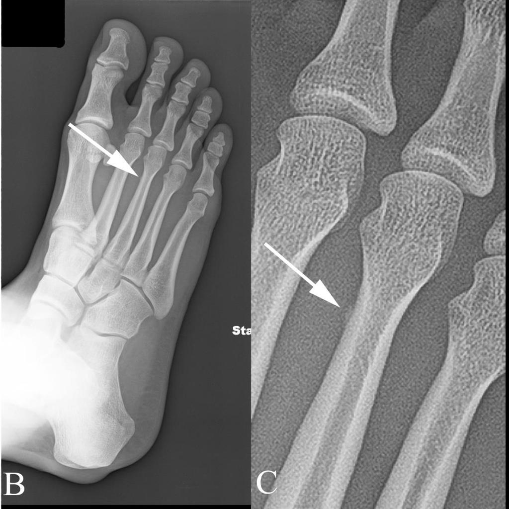 12/22/2012 Radiology Quiz of the Week #104 Page 4 IMAGING STUDY QUESTIONS AND ANSWER Imaging questions: 1) What type of study is shown? An anteroposterior (AP) and oblique plain film of the foot.