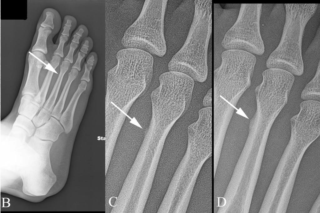 12/22/2012 Radiology Quiz of the Week #104 Page 5 The patient was seen by a podiatrist, who placed the patient in a surgical shoe with accommodating padding and instructed the patient to rest for at