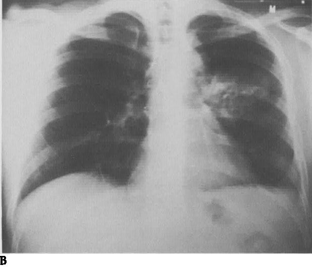 (A) Posteroanterior chest roentgenogram demonstrating bilateral pulmona y metastases.