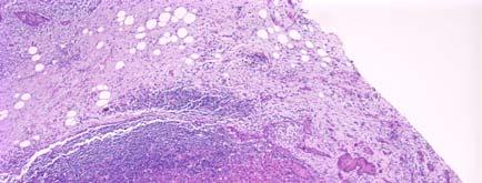 Metastases Regional lymph nodes Size of node Location