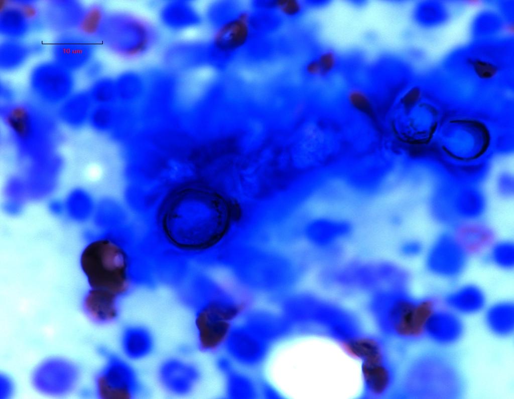 Blastomycosis Organisms are 7 14 microns in diameter, deeply basophilic,