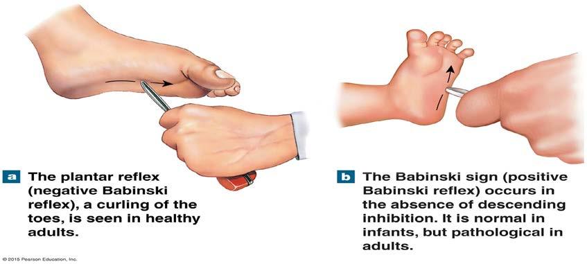 Upper motor neuron lesions Babinski reflex Plantar extension (normal response in infants) Plantar flexion (normal response in adults) Positive Babinski sign in adults