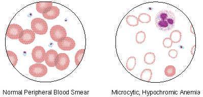 Genetic hemoglobin disorders (hemoglobinopathies)