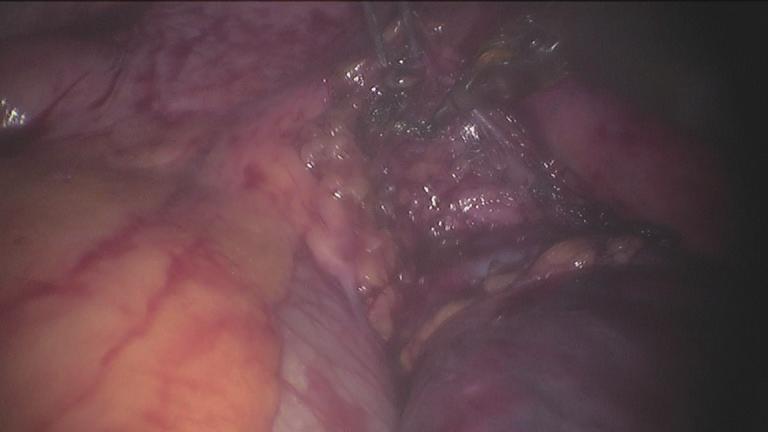 Then the chest was closed after a chest drainage tube was