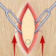 Plan the cranial hole so that the implant will ultimately lie under the