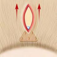 One needle-like tip of the tool fits into the hole in the ENDOTINE Forehead