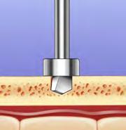 the ENDOTINE TRIPLE PROCEDURE 1 MAKE THE INCISION High-Performance Predictable brow elevation and secure tissue fixation provided by