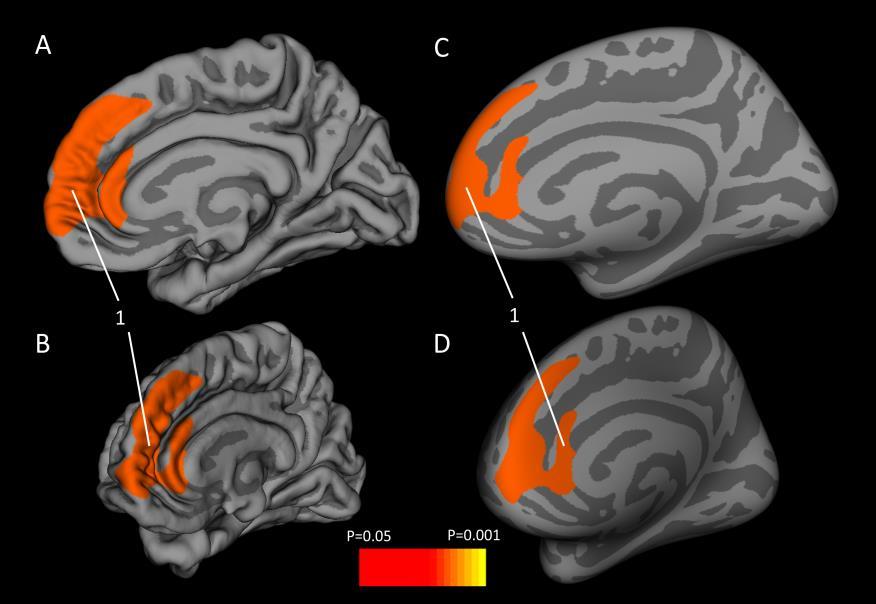 Brain Structure: Differences in children who have experienced maltreatment For example: Reduced grey matter volume (GMV) in the left orbitofrontal cortex Reduced cortical thickness in an extended