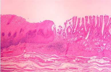 Main Types of Oesophageal Cancer Squamous cell carcinoma Men= women Tobacco