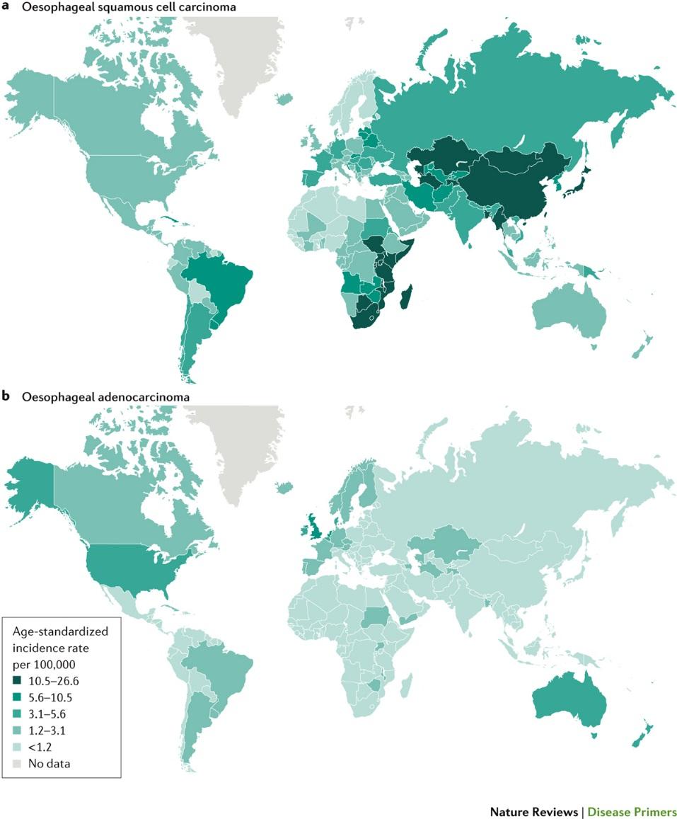 Global annual incidence of oesophageal cancer Males Adenocarcincoma Squamous cell carcinoma Females