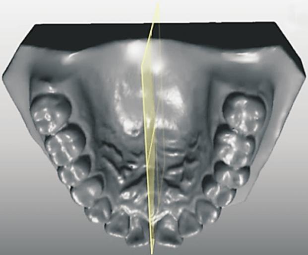 The three reference planes (horizontal, coronal, and midsagittal planes of the 3D virtual maxillary models) were used to locate the point of origin and to measure the linear and angular variables