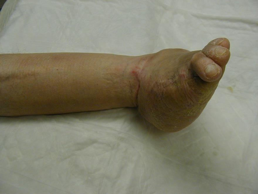 Charcot Foot Deformity Neuro-arthropathy Increased perfusion softens