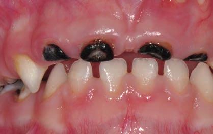1 WHAT IS AN EARLY LESION? 2 DIAGNOSING AN EARLY LESION Fig. 1 - Early lesions in a 16-year-old adolescent. Application of fluoride varnish.
