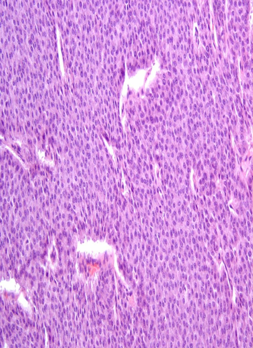 Solid, Cellular Pattern Proliferation of neoplastic cells