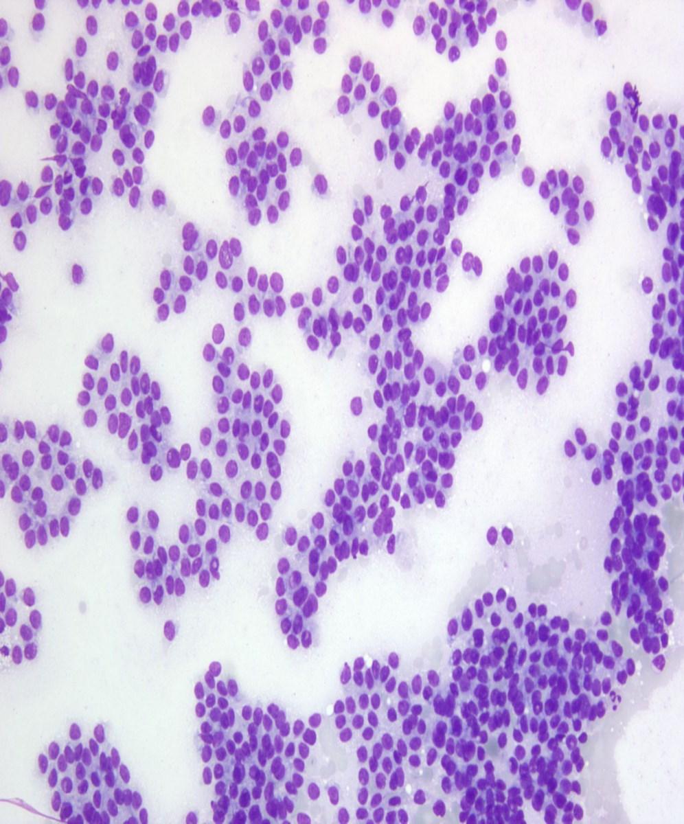 Pancreatic Neuroendocrine Tumor (PanNET) Acinar Cell