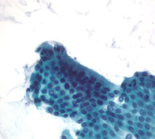Original Article Cytological Criteria of High-Grade Epithelial Atypia in the Cyst