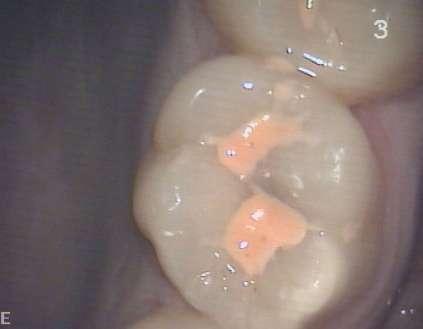 dentine decay fujivii