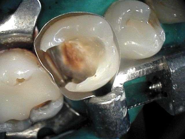 ozone therapies in dental care integrated treatment: Tofflemyre matrix band surrounds 4.5 after cavity preparation.