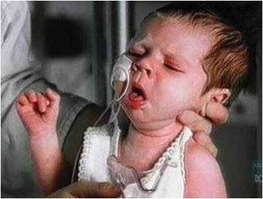 Pertussis Whooping cough Starts with a mild URI without fever (Catarrhal stage), then Paroxysmal Cough, Whoop, Post- Tussive Emesis for >2-3 weeks. Affects infants, children, adolescents, adults ~48.