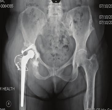 2 Case Reports in Orthopedics Figure 1: AP radiograph of pelvis revealing previous right total hip arthroplasty.