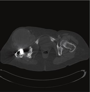 The radiograph also revealed decreased bone mineralization and severe osteolysis especially in the proximal femur with complete resorption of the greater trochanter. CT scan with contrast showed a 15.