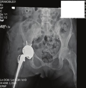 Her impingement of the femoral neck implant on the posterior aspect of the acetabular cup resulted in dislocation due to lack of any anterior soft tissue restraint.