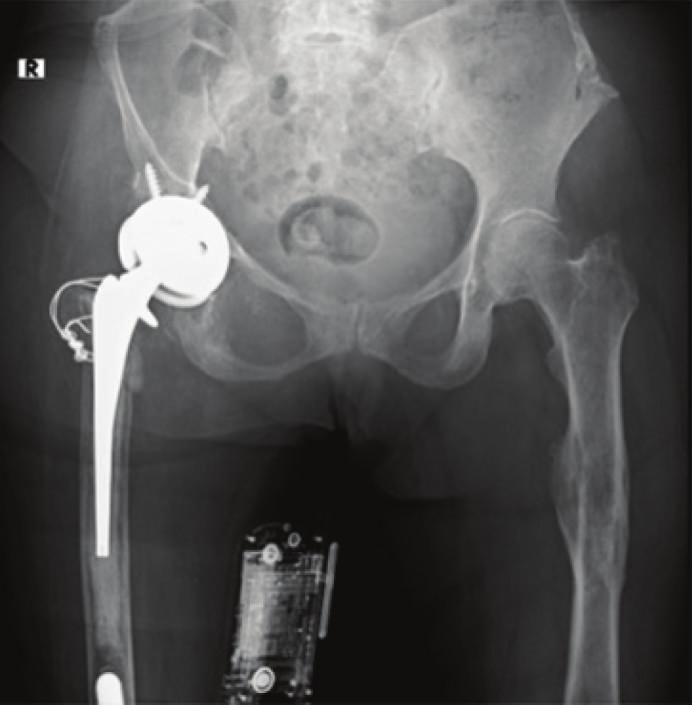 4 Case Reports in Orthopedics Figure 9: 3 months after operation. Figure 11: 8 months after operation. 3. Discussion Figure 10: 5 months after operation.