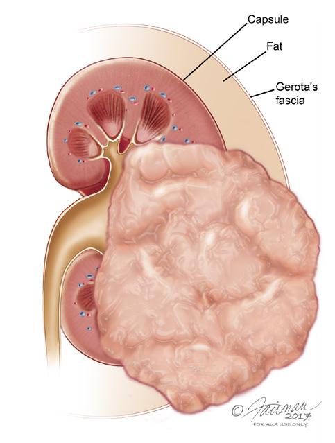 Tumor size helps in assessing risk for cancer developing. Kidney cancer is staged using the tumor node metastases (TNM) system.