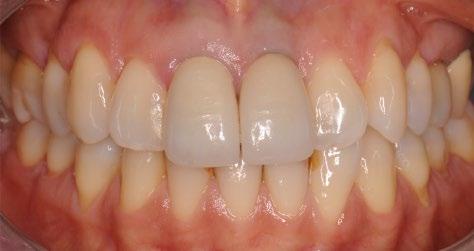 The tooth/implant complex did not show any further sign of infraocclusion in relation to the adjacent lateral incisors.