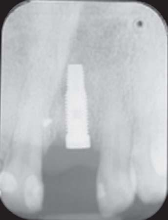 Implant was placed 3 millimeters apically to the adjacent tooth CEJ without reducing alveolar bone height.