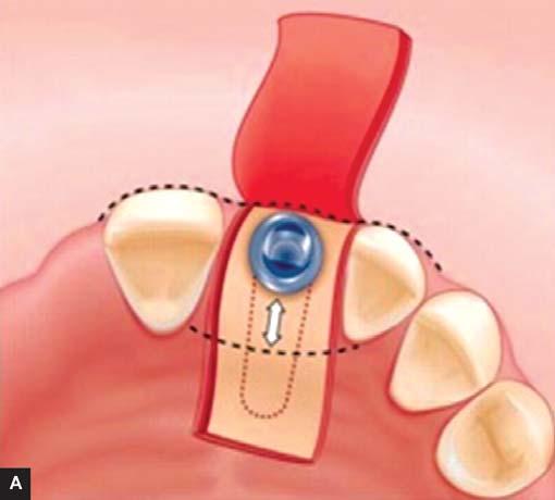 5 to 2 millimeters of clearance (d and b) is required between implant and adjacent tooth for proper osseointegration and decreased risk of damage to adjacent teeth.