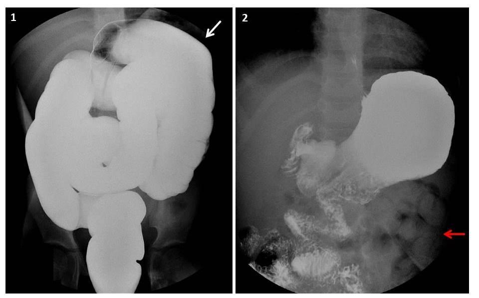 2: Intestinal malrotation: 2. Barium enema of a patient with history of bilious vomiting.