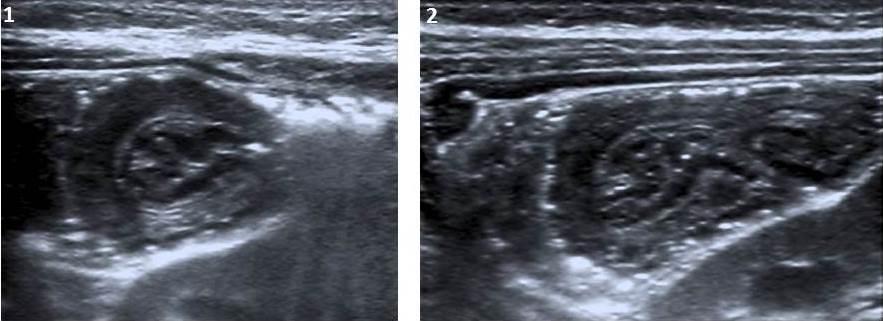 Fig. 5: Transverse and longitudinal ultrasonographic images show